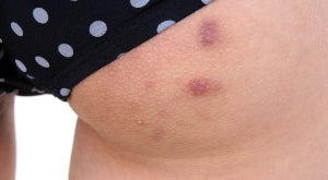 Why Do I Have Ingrown Hair on Nipple?