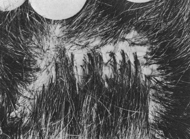 Pili Multigemini: Causes, Risk Factors, and Treatment