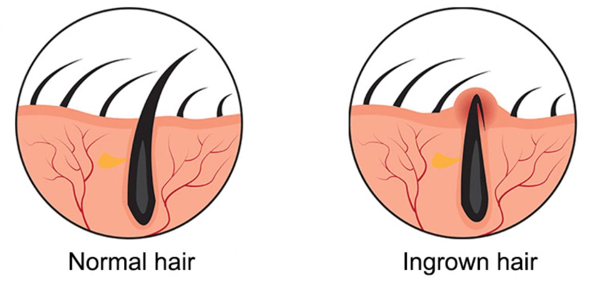 Ingrown Hair: What It Looks Like, Causes, Treatment & Prevention
