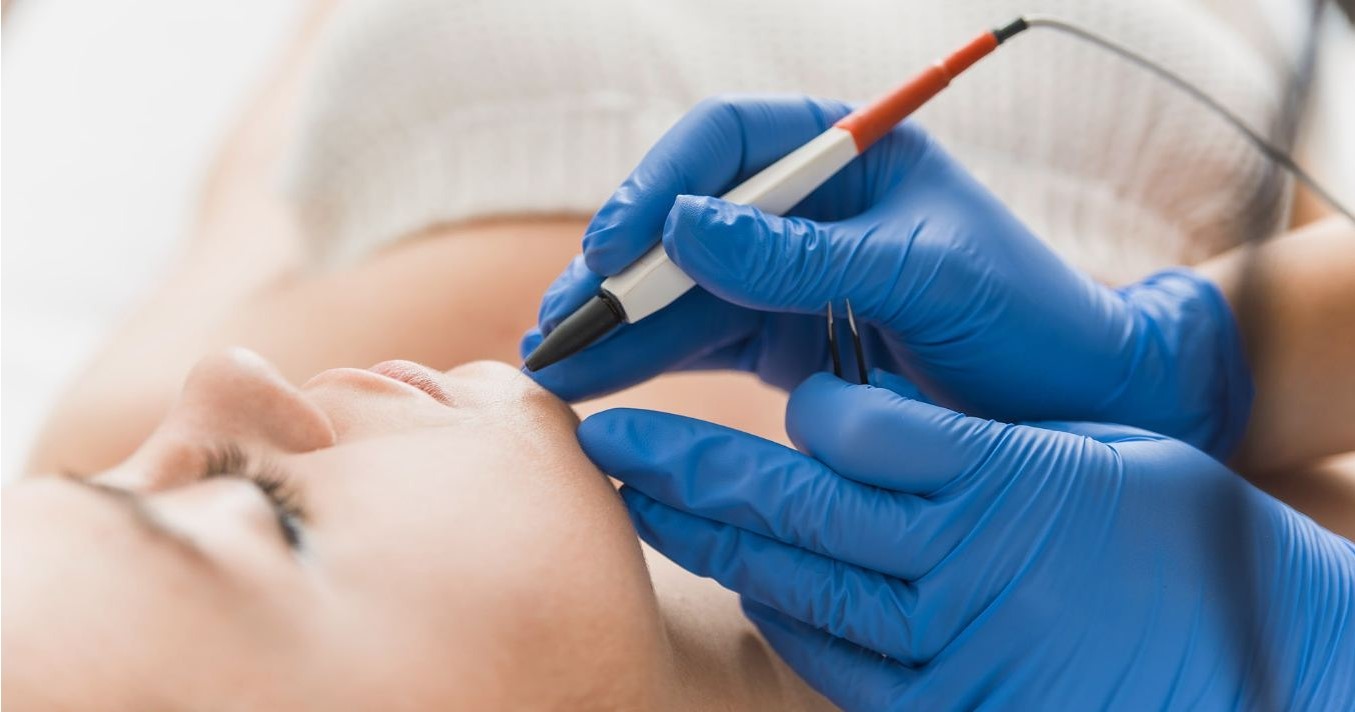 How To Choose The Best Electrolysis Hair Removal Near Me?