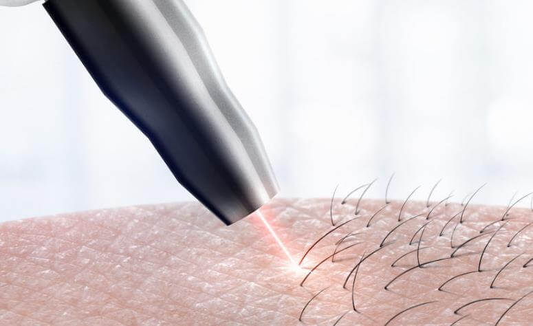 Laser Hair Removal at Home vs. Salon: Which Should You Choose?