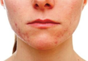 Pluck Hair: Safety Tips, Side Effects and FAQs