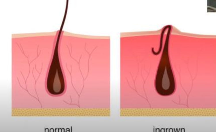 How to Get Rid of Underarm Hyperpigmentation? | Dr. Sanober Doctor