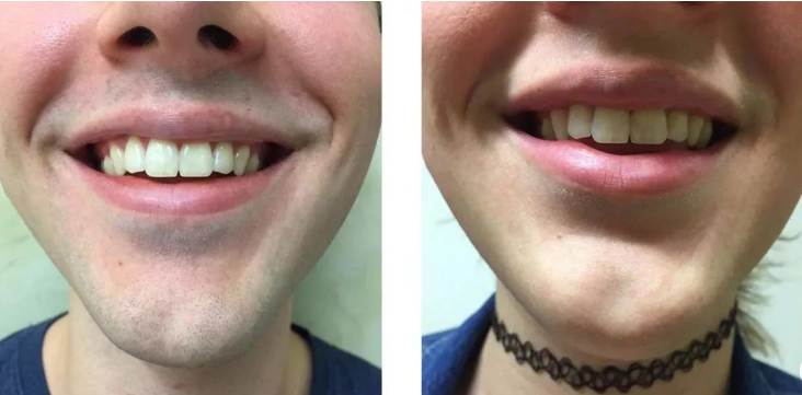 Laser Hair Removal Transgender: Is it the Right Choice?