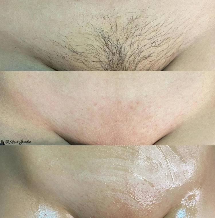 Vajacial Treatment 101: Everything Explained