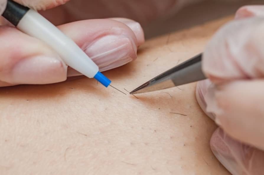 How Long Does Electrolysis Last? How Many Sessions Are Needed?
