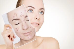IPL for Acne: Does IPL Get Rid of Pimples?