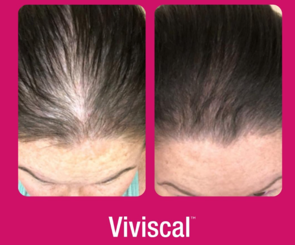 Viviscal vs. Nutrafol: Which One is Better for Hair Growth?