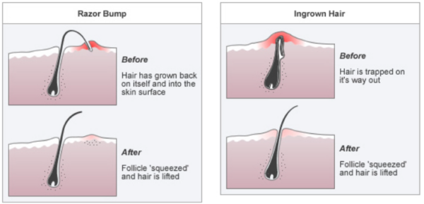 How to Prevent Ingrown Hairs After Shaving? (12 Ways)
