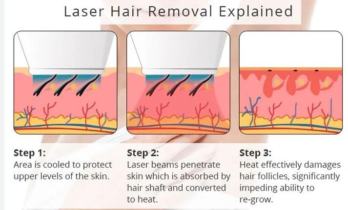 Face Laser Hair Removal: Procedure, Benefits, and More 