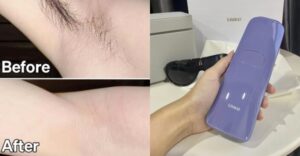 Ulike vs. JOVS: Which IPL Hair Removal is Better?